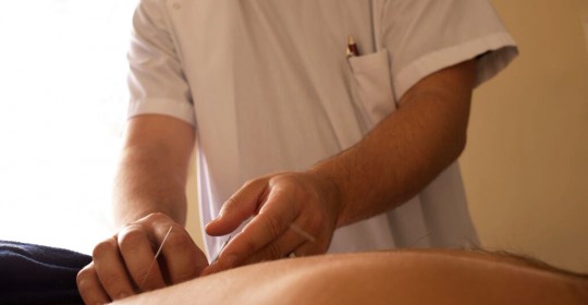 Acupuncture